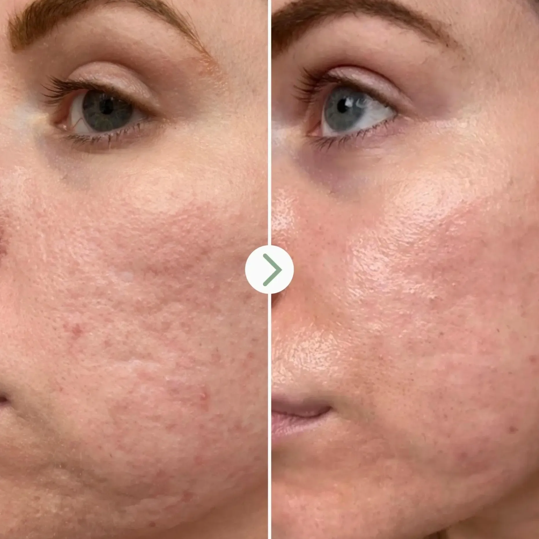Pai Hyaluronic Acid 0.3% Hydrating booster seerumi 10ml